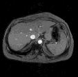 Small nodular liver Intra-abdominal collaterals Ascites