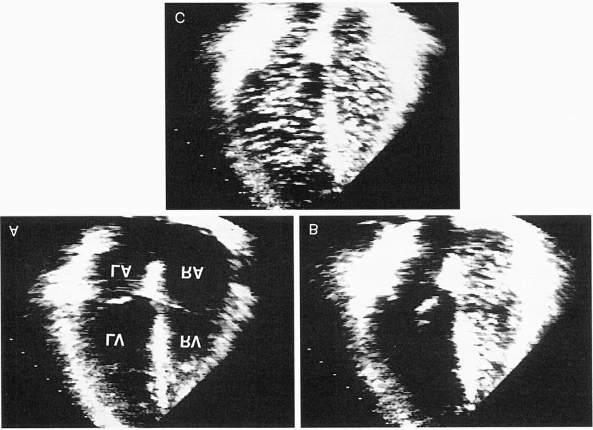 Contrast-enhanced echocardiography with