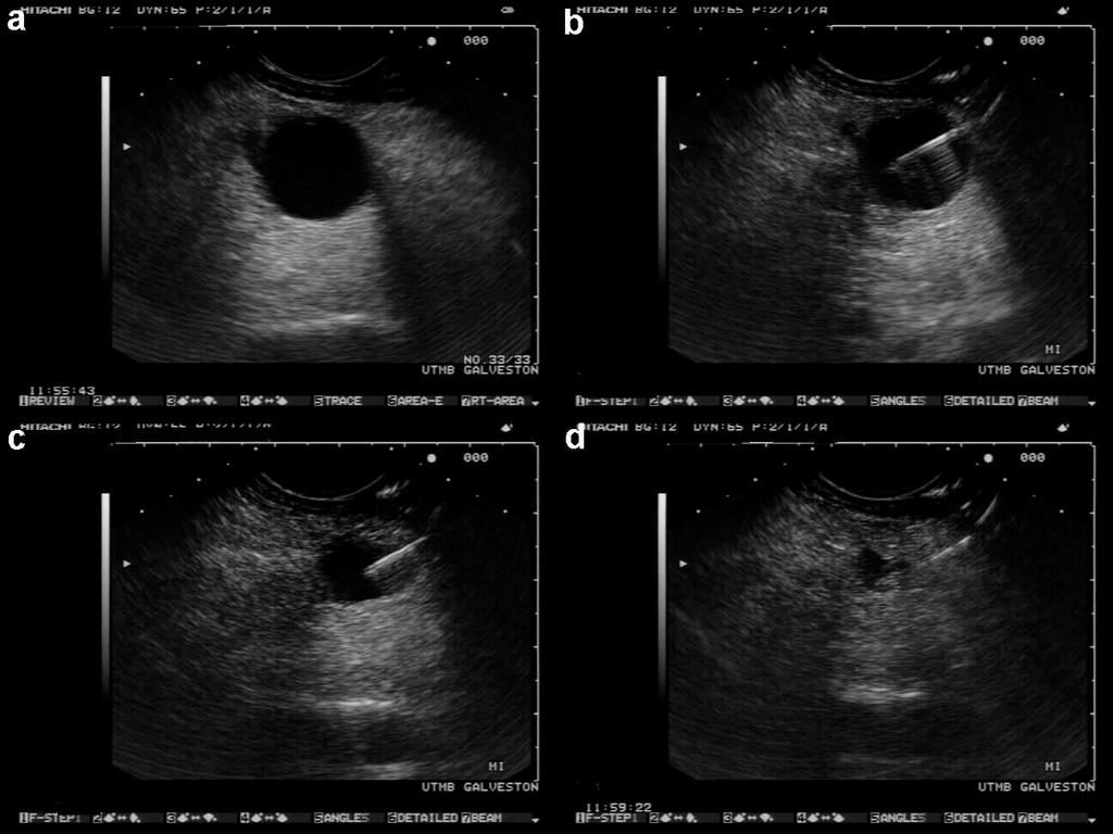 Figure 1. a. Unilocular cystic lesion in pancreatic body as imaged with a linear echoendoscope in a woman with no symptoms attributable to this lesion. b. Linear EUS guided puncture of the cystic pancreatic lesion shown in Figure 1a.