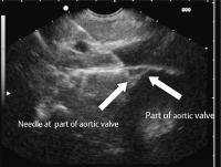 the left atrium, aortic valve, and coronary artery Of