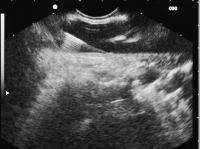 pericardial fluid was successfully aspirated in 2 and