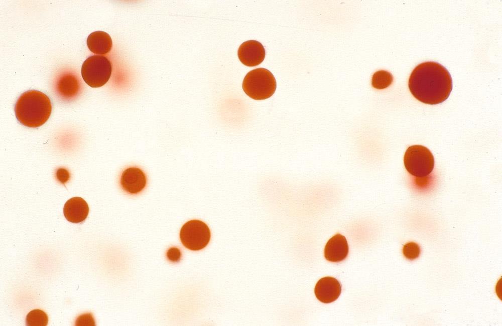 triglycerides (chylomicrons) DD