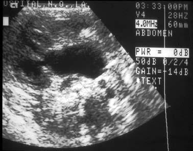 ultrasound Q3-4mo -If diuretic renal scan is