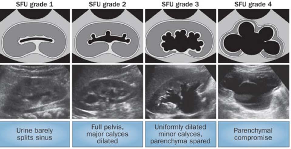 Society of Fetal Urology Grading System Grade 0 1 2 3 4 Central Renal Complex Normal Slight splitting Splitting within kidney borders Only minor