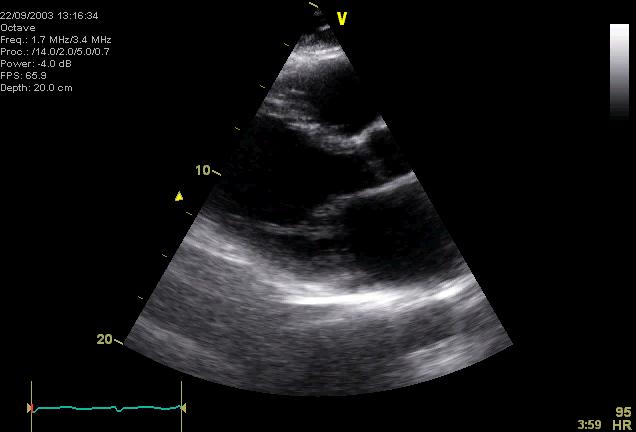 Hyperthyroid-tachycardiomyopathy Rate related left ventricular dysfunction and heart