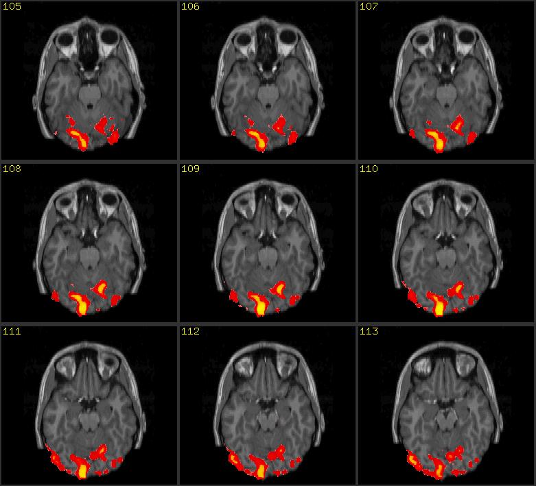 v=glxu80ge7vg Cerebrum MRI image of the head Magnetic Resonance