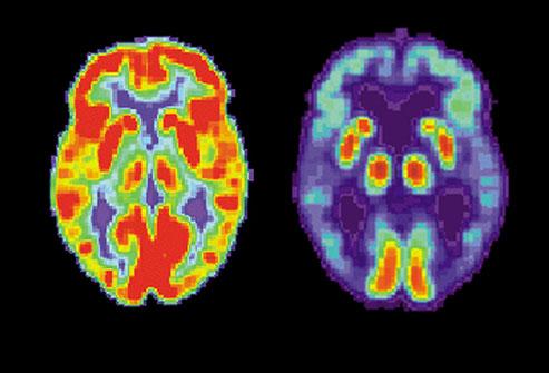 demolished Destroys memory and thinking skills PET scan noninvasive