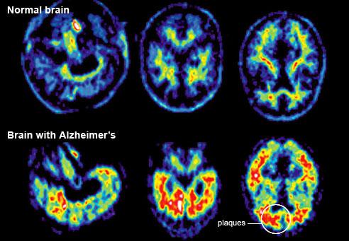 Plaque marker PET scan using labeled PiB protein marker to light up amyloid plaques High levels of plaque are seen in an Alzheimer s patient But some healthy