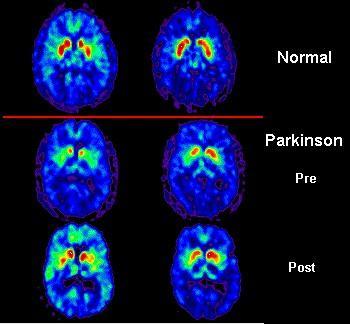 Figure 29: PET scans revealing the activity of neurons within the caudate nucleus in normal subjects as well a patient with Parkinson s disease before (pre) and after (post) L-DOPA treatment.