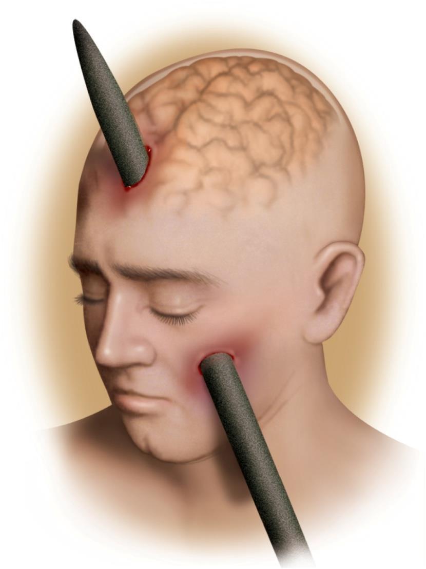 Lobotomy of Phineas Gage severe injury with metal rod injury to the ventromedial region of both frontal lobes extreme personality change
