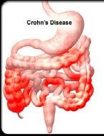 Crohn s Disease Inflammation can involve any part of the GI tract Inflammation is transmural Fistula