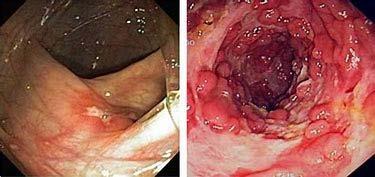 Cobblestoning Inflammation is segmental Rectal spraring Terminal ileum involved Granuloma on biopsies