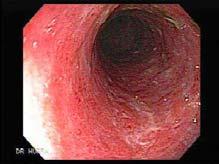 Endoscopic Appearance of Ulcerative Colitis Inflammation is superficial Diffuse Rectal involvement Normal terminal ileum Assessment of Disease Activity Crohn s Disease Activity Index (CDAI) Harvey