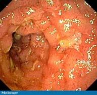 She started on Lialda 1/2015, EGD, colonoscopy and CT small bowel performed for ongoing symptoms. Colonoscopy with right sided inflammation with a stricture.