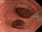 Role of Endoscopy Confirm diagnosis Differentiate between Ulcerative Colitis vs Crohn s Disease Obtain histologic confirmation Assess disease severity and distribution Assess mucosal healing
