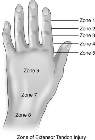 Taylor_PS_C1-10.qxd 07/10/2004 10:57 AM Page 109 Ch. 8: Hand and Upper Extremity 109 Figure 8-2 Extensor tendon zones.