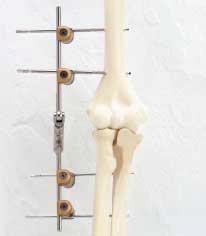 If the pathology has modified the joint contour requiring refashioning of the joint surface, with or without an interposition membrane. When an interposition procedure is performed.