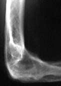 Rheumatoid arthritis: right elbow joint