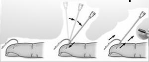 28190 - Removal of foreign body, foot; subcutaneous Soft