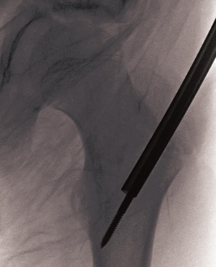 Replace the 10 or 12mm Tissue Protector with the 7mm Exchange Tube (Figure 11). Place the 7mm Exchange Tube into the femoral canal and withdraw the 3.