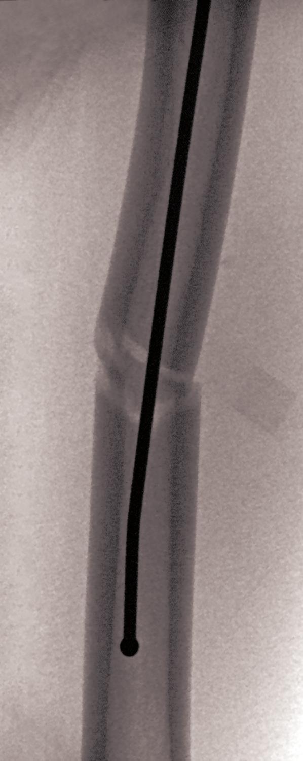 7mm Ball Tipped Reaming Rod into the distal femur and impact it into the lateral femoral metaphysis to a depth of approximately 1cm proximal to the distal femoral physis (Figures 18a
