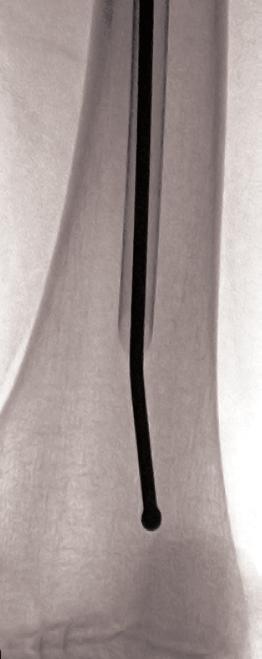 Place the Exchange Tube over the 2.7mm Ball Tipped Reaming Rod and insert into the reamed femoral canal (Figure 23). Verify placement on radiograph (Figure 24). Remove the 2.