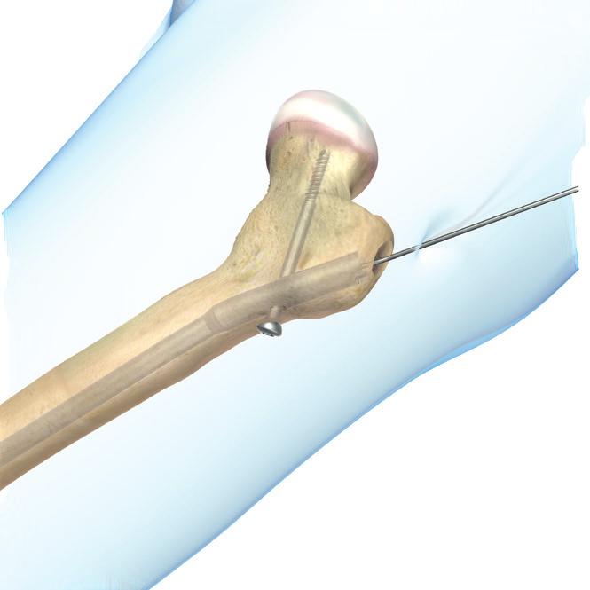 0mm wire Make an incision through the scar created when inserting the nail. Bluntly dissect down to the greater trochanter. Place the 2.0mm Guide Insertion Wire, or any 2.