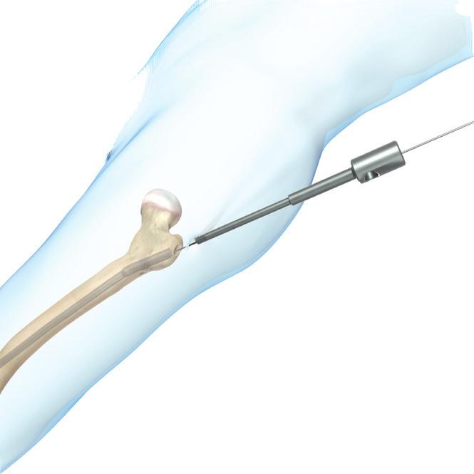 Remove all proximal and distal locking screws