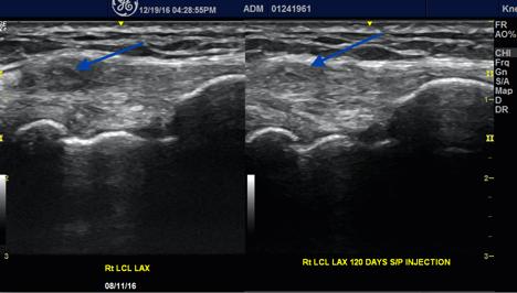 Findings: Sonographic evidence of decreased infra-patellar fat pad edema. Sonographic findings suggestive of increased echo-texture and substance of the LCL, MCL, LM, and MM. Randy E.