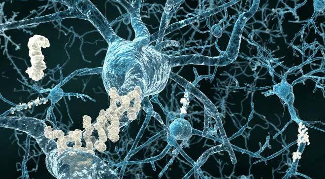 Amyloid plaques in brain tissue July