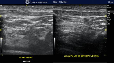 Below is a before and after demonstrating sonographic evidence
