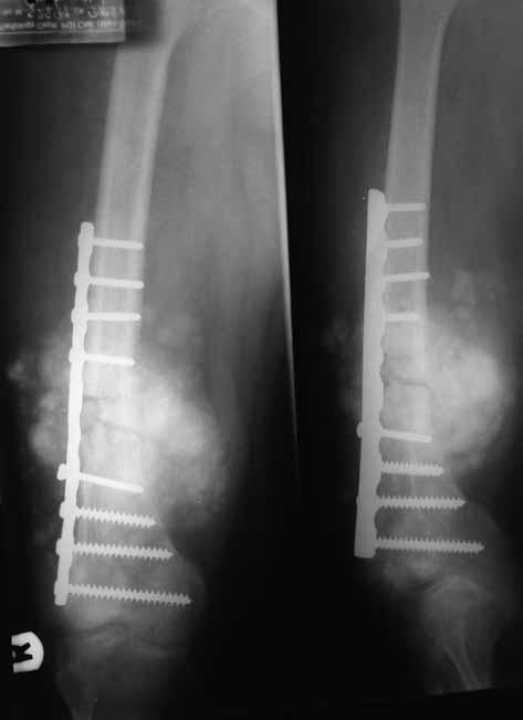 560 R. K. SEN, L. A. VEERAPPA, R. K. VASISHTA, V. GUPTA Fig. 5. Anteroposterior and lateral radiograph of the lesion 3 weeks after excision biopsy and fixation.