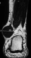 FIGURE 26 Nerve sheth tumors -. Schwnnom in 30-yer-old womn involving the thum region.