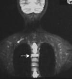 chest wll, lrger on the right nd isointense to muscles. The findings re p t h o g n o m o n i c. Figure 28.