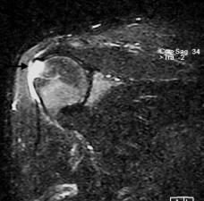 FIGURE 32. Sgittl STIR imge in young mn with cute shoulder pin. There is lrge full thickness ter t the insertion site of the suprspintous tendon. The tendon gp is filled with fluid (rrow). FIGURE 33.