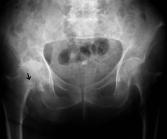 HIP FRACTURE Hip frcture is common trumtic disorder in prticulr relted to motor vehicle ccident.