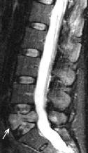 Cuses of Bck Pin other thn Osteoporosis Bck pin is the second most common clinicl complint encountered y primry cre physicins [36].
