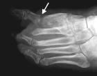 FIGURE 44 Dietic foot infections -. Osteomyelitis nd septic rthritis involving the first mettrso-phlngel joint ( r r o w). Rdiogrph () revels significnt destruction of the joint.