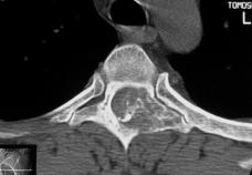FIGURE 7 Osteolstom in 40-yer-old mn. A lrge destructive lesion is noted involving the left posterior elements of n upper thorcic verterl ody with impingement on the spinl cnl.