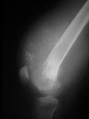This ppernce should rise the possiility of firous dysplsi (Figure 17). The fllen frgment sign: This sign indictes the presence of pthologic frcture in simple cyst, typiclly in the humerus (Figure 18).