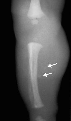 RADIOLOGICALAPPROACH FOR IMAGING SOFT TISSUE TUMORS There re four types of soft-tissue msses tht ptients cn present with nd they include: mlignnt soft-tissue tumors, enign soft-tissue tumors,