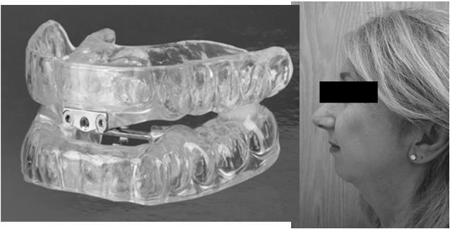 MANDIBULAR ADVANCEMENT DEVICES Advancement of mandible Enlarge airway behind tongue, but may also enlarge airway behind palate ORAL APPLIANCE THERAPY: ANTERIOR MANDIBULAR REPOSITIONING Ferguson;Chest