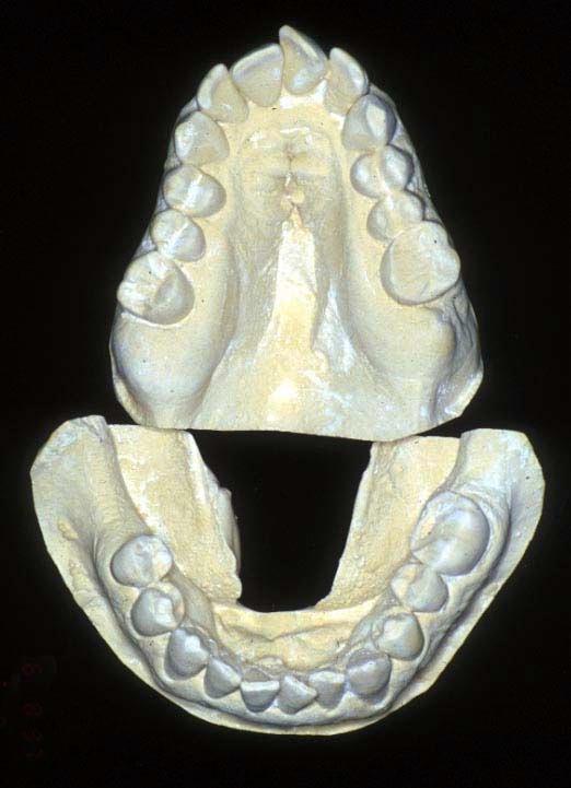Upper and lower models of an adult demonstrating a high palate and narrow
