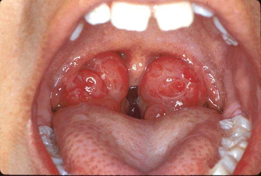A53 Massive tonsils