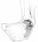 Ankle Sprain ~ Grade 1 Ankle Sprain ~ Grade 1 S93.411 Sprain of ankle calcaneofibular ligament, right S93.