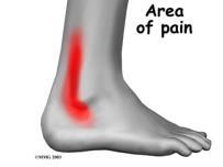 71 Peroneal tendinitis, right leg M76.72 Peroneal tendinitis, left leg M77.51 Other enthesopathy of right foot M77.