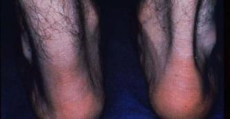 012 Strain of left Achilles tendon M76.61 Achilles tendinitis, right leg M76.