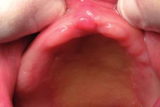 Clinical appearance of the  papillary hyperplasia