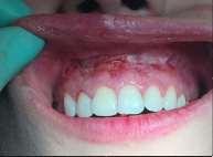 In conservative dentistry, the laser therapy can be used for: decays, the sterilization of the infected root canals, granuloma and radicular cysts treatment without surgical procedures,