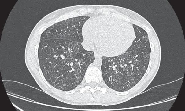 Histologically, the most frequently described pattern in adults is UIP, but NSIP, organising pneumonia or desquamative interstitial pneumonia have also been reported.